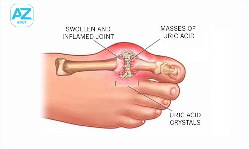 dấu hiệu bệnh gout là dạng viêm khớp sưng đỏ ở các vị trí khớp trên cơ thể khiến bệnh nhân đau dữ dội